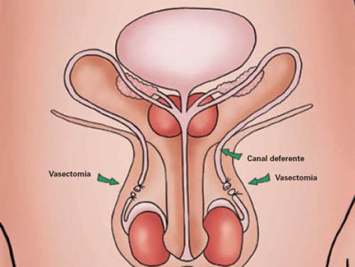 O procedimento é utilizado para o controle da natalidade e é realizado através de uma pequena cirurgia (Foto: Imagem Ilustrativa)